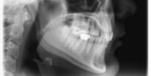  Панорамная боковая рентгенография черепа