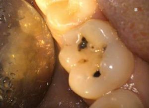   рецидив кариеса (поражение тканей зуба под пломбировочным материалом)